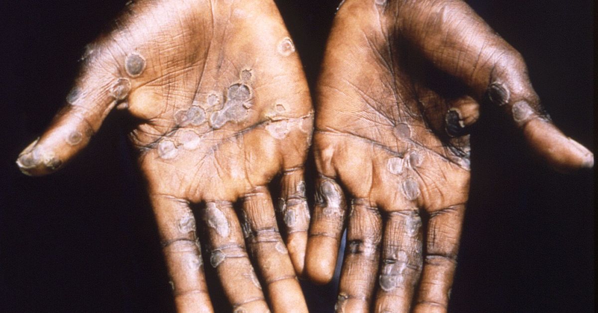 ****** Re-Title ******NIH Knew Researchers Allegedly Smuggled Monkeypox Into the US, but Sat on the Story for Five Months