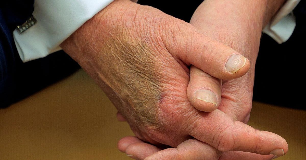 Doctor Explains Trumps Hand Bruises In One Boring SentenceMedia Turns It Into A Full-Blown Crisis